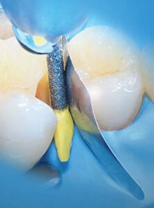 polydentiapro interproximal tooth protect.matrixen